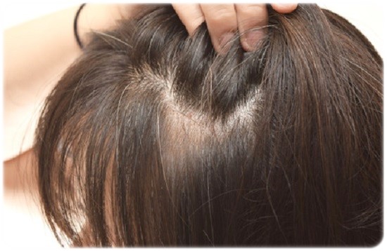 女性の側頭部の薄毛・脱毛 原因と育毛剤による改善効果