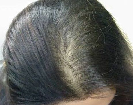 女性の頭皮地肌が透けて目立つ薄毛の症状