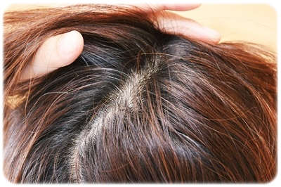 女性用育毛剤（医薬部外品）の初期脱毛について